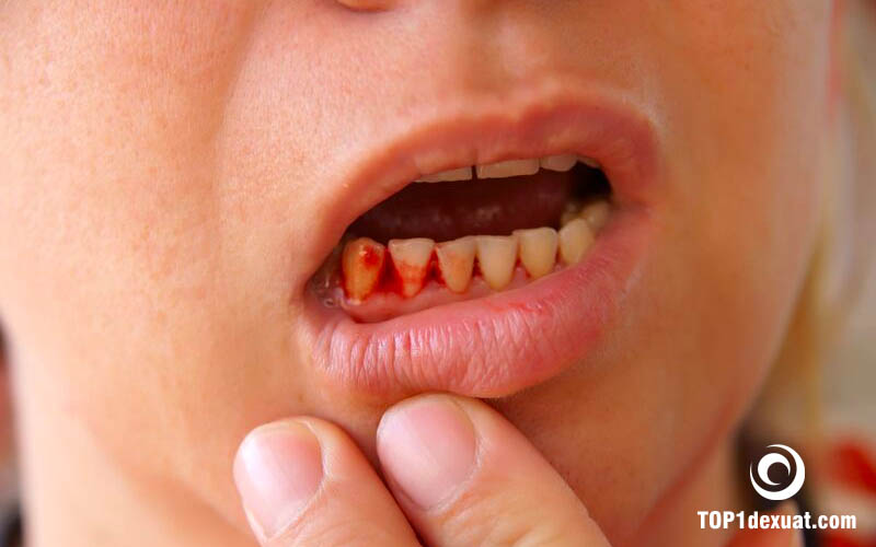 chảy máu chân răng là gì
