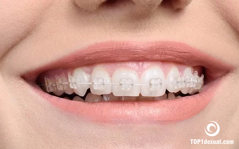 So sánh: Nên niềng răng mắc cài sứ hay kim loại