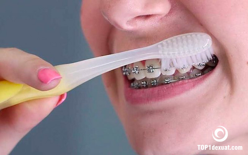 chu trình đánh răng cho người niềng răng