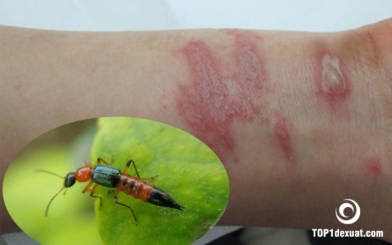 #1 Viêm da tiếp xúc côn trùng: Triệu chứng và cách điều trị